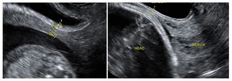 uterine scar thickness first trimester